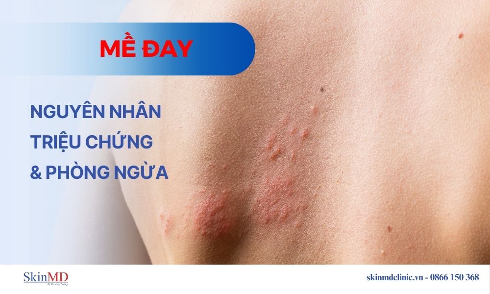 Mề đay: Nguyên nhân, triệu chứng biến chứng và phòng ngừa