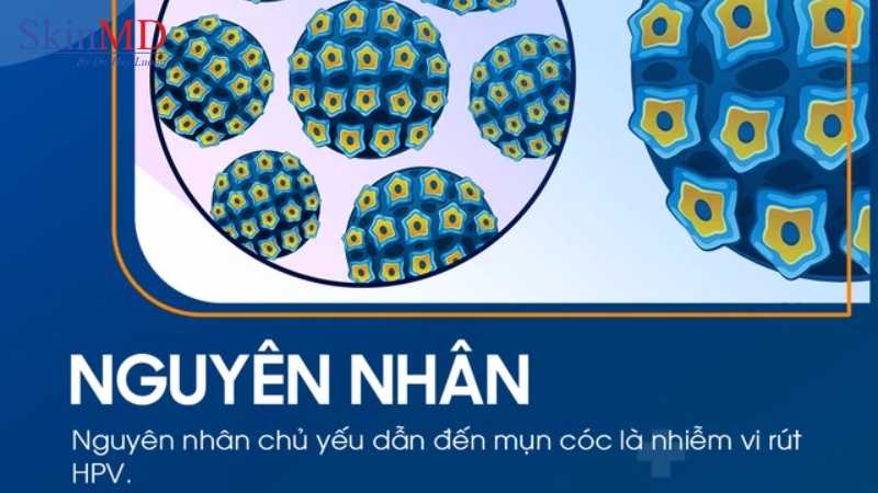 Nguyên nhân chủ yếu dẫn đến mụn cóc là nhiễm virus HPV