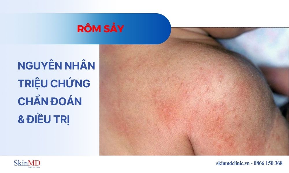 Rôm sảy: Nguyên nhân, triệu chứng, chẩn đoán và điều trị