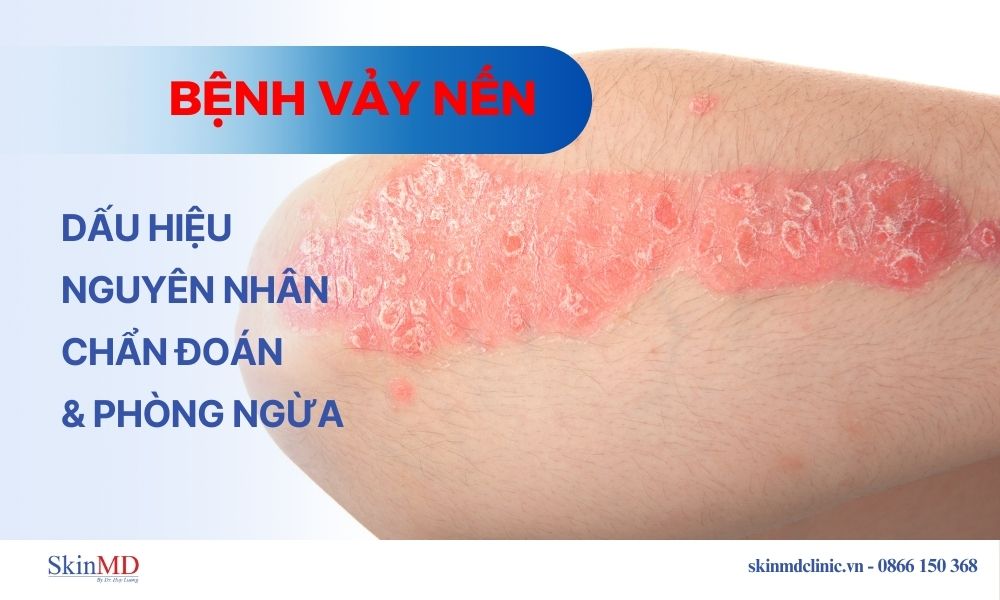 Bệnh vảy nến: Dấu hiệu, nguyên nhân, chẩn đoán và phòng ngừa