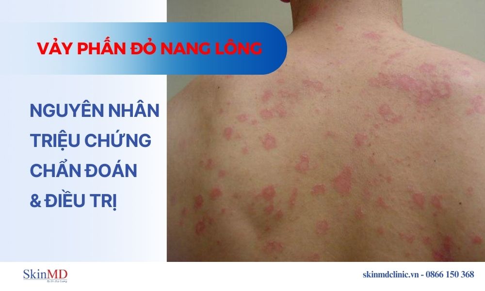 Nguyên nhân, triệu chứng và cách điều trị vảy phấn đỏ nang lông