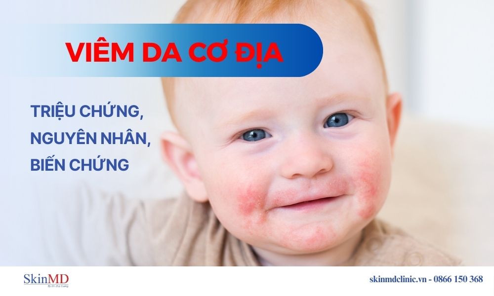 Viêm da cơ địa: Triệu chứng, nguyên nhân, biến chứng và phòng ngừa