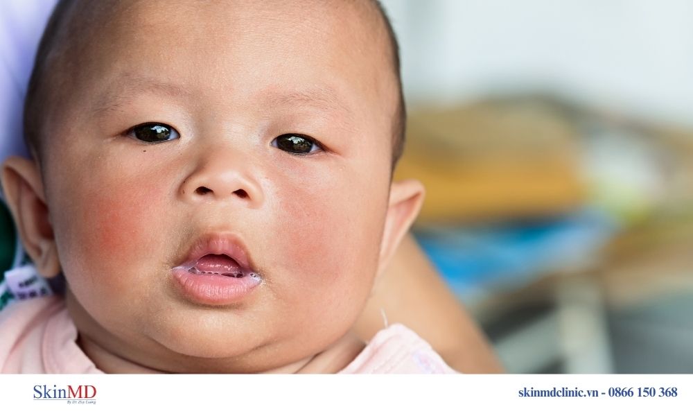 Viêm da cơ địa là gì?