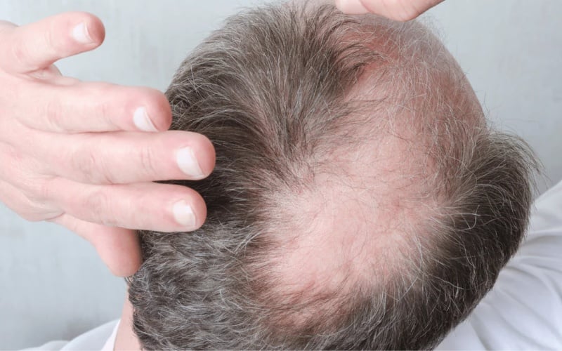 Rụng tóc nhiều ở người đàn ông