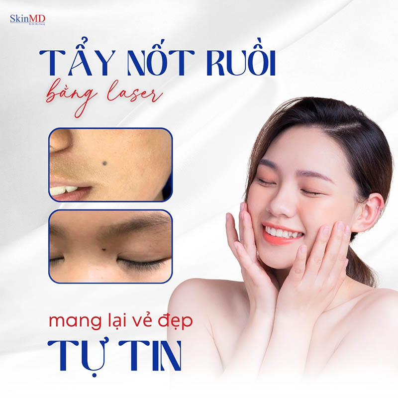 Tẩy nốt ruồi hiệu quả nhờ bác sĩ da liễu bắc ninh