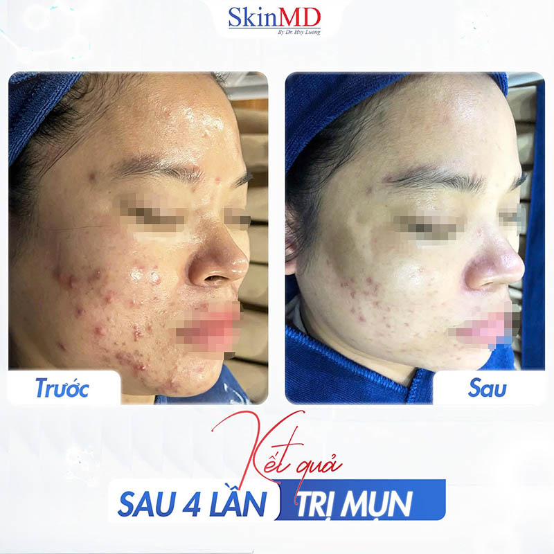 Trị mụn hiệu quả nhờ bác sĩ da liễu bắc ninh