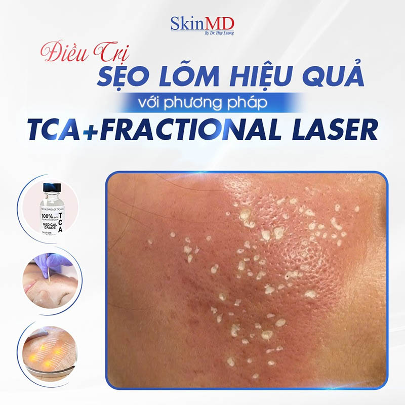 Trị seo lõm hiệu quả bởi bác sĩ da liễu bắc ninh